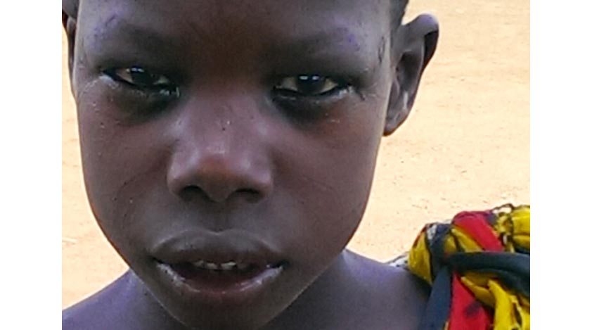 A close-up photo of Lochin's eyelids after surgery